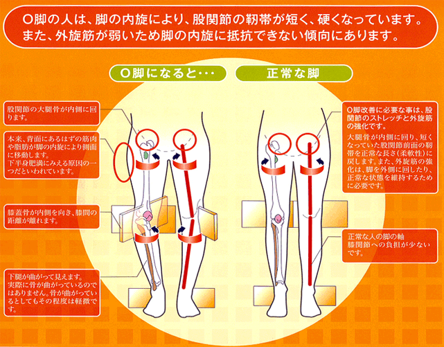 O脚の人は、脚の内旋により、股関節の靭帯が短く、硬くなっています。また、外旋筋が弱いため脚の内旋に抵抗できない傾向にあります。